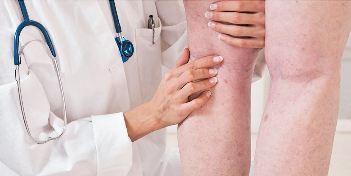 Doença Venosa Crónica – Prevenir e controlar