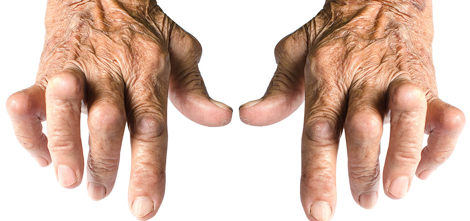 Artrite reumatoide: fale com o seu médico