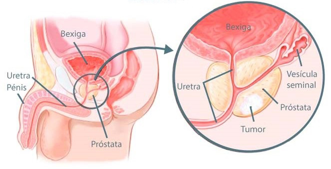 Cancro da próstata: sinais de alerta, prevenção e diagnóstico
